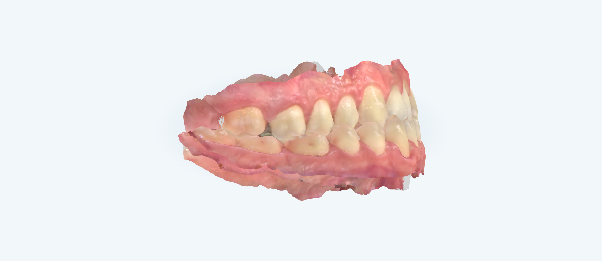 Underbite treatment comparison frontal view before